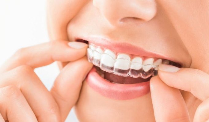 What's New In Dental Braces