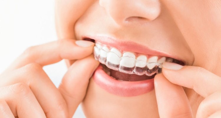 What's New In Dental Braces